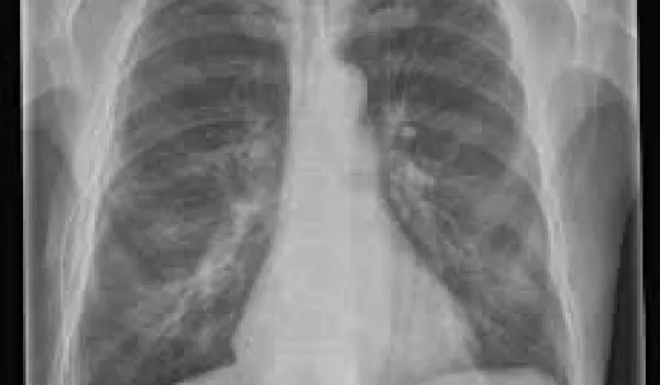 At least 724 people died during 2019 from the aggressive and incurable cancer mesothelioma, which is chiefly caused by asbestos exposure, according to a report released today by the Australian Institute of Health and Welfare (AIHW).